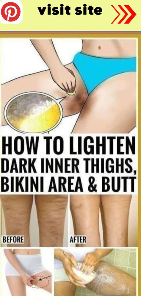 How to lighten dark inner thighs naturally Dark Inner Thighs, Healthy Living Inspiration, Tiny Shorts, Health Tips For Women, Inner Thigh, Micro Mini, Health Matters, Health Awareness, Healthy Body