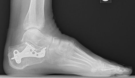 Calcaneus Fracture, Types Of Fractures, Fracture Healing, General Anaesthesia, Bone Fracture, Wound Care, After Surgery, Wound Healing, Skin Healing