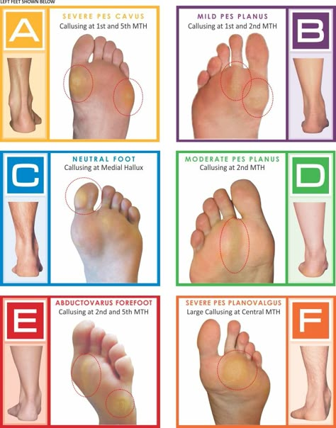 Pediatric Physical Therapy Activities, Massage Marketing, Foot Reflexology Massage, Foot Anatomy, Pediatric Physical Therapy, Foot Exercises, Achilles Tendon, Reflexology Chart, Degenerative Disease