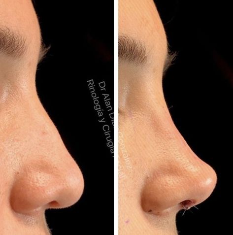 Ski Slope Nose Job, Tinkerbell Tip Lift Nose, Perfect Nose Front View, Nose Job Inspiration, Ethnic Nose Job, Nose Surgery Rhinoplasty, Rhinoplasty Nose Jobs, Job Inspiration, Pretty Nose