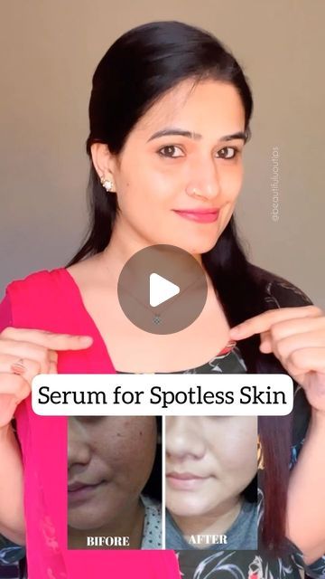 Potato Remedies For Skin, Natural Serum For Face, Hyperpigmentation How To Get Rid Of, Alovera For Skin, Potato Juice For Skin, Dull Skin Remedies, Get Rid Of Hyperpigmentation, Face Remedies, Spotless Skin