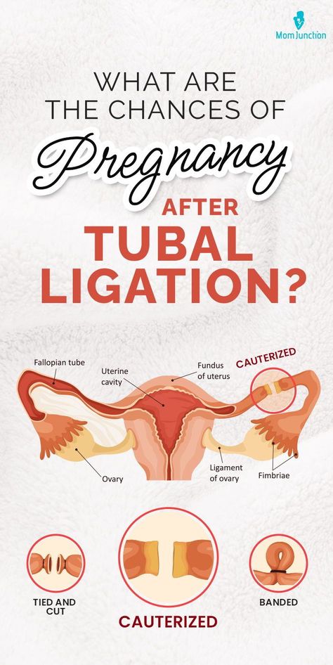 Tubal Reversal Surgery, Tubal Removal Recovery, Tubal Litigation Recovery, Pregnancy After Tubal, Tubal Reversal, Symptoms Of Pregnancy, How To Conceive, Chances Of Pregnancy, Fallopian Tubes