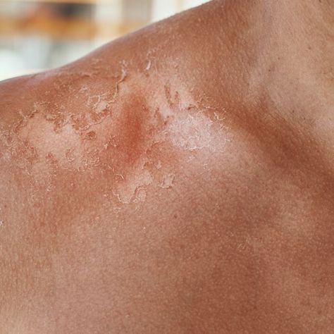 Sunburn on the shoulders of men. Shoulders with a hurt skin fron sun burn, closeup Burns On Skin, Sun Burn, Sunburnt Aesthetic, Sunburn Aesthetic, Skin Peeling From Sunburn, Sunburn Face, Sunburn Lotion, Best Sunburn Relief, Beard Burn