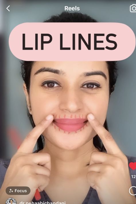 Lip Filler For Smoker Lines, Smokers Lines, Botox Lips, Lip Wrinkles, What To Use, Upper Lip, Lip Fillers, How To Line Lips, Musical Instruments