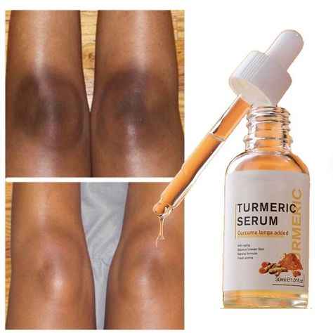 Face Whitening Serum, Turmeric Serum, Forehead Acne, Natural Acne Remedies, Brown Spots Removal, On Knees, Dark Spots On Skin, Dark Spot Corrector, Glow Serum