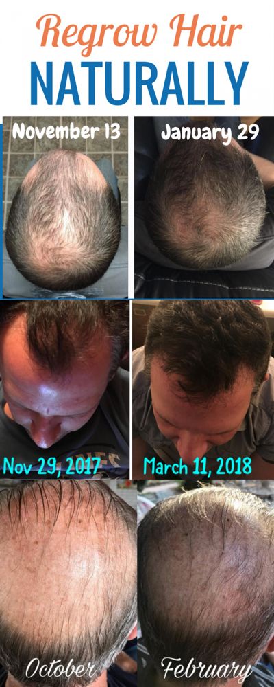 Regrow Hair Products - 7 Real Men Tell All With Before & After Pictures Regrow Hairline, Hair Lossing Tips, Hair Lossing, Hair Growth Pills, Regrow Hair Naturally, Natural Hair Oil, Natural Hair Growth Remedies, Longer Hair Growth, Coffee Diet