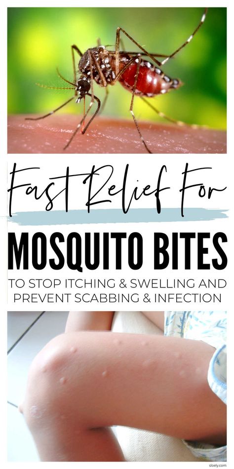 Fast relief for mosquito bites to stop itching, swelling & scabbing with natural ingredients in your kitchen you can use for quick DIY home remedies. #mosquitobite #homeremedies #diyremedy #naturalremedies Mosquito Bites Remedy, Misquote Itch Relief Diy, Essential Oil For Mosquito Bites Itch Relief, Mosquito Bite Remedy Repellent, Diy Itch Relief Insect Bites, Natural Mosquito Bite Relief, How To Stop Itching From Mosquitos, How To Soothe Mosquito Bites, Home Remedy For Mosquito Bites