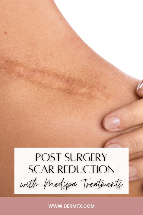 Click to learn more about how to treat surgical scars! Scar Reduction, Cosmetic Treatments, Post Surgery, Med Spa, Flawless Skin, Surgery, To Learn, Skin