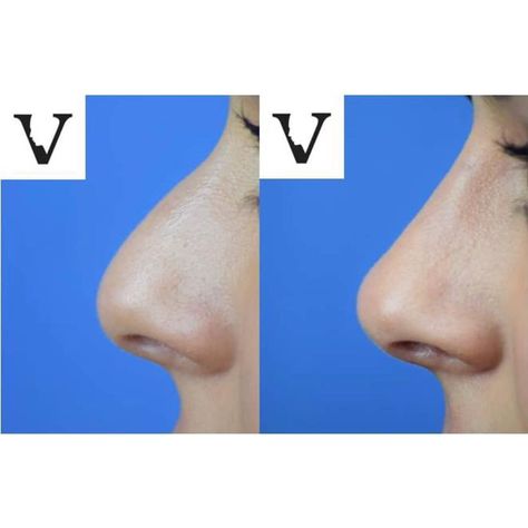 Asian Nose Job, Asian Nose, Non Surgical Nose Job, Nose Rhinoplasty, Nose Fillers, Nose Reshaping, Tree Drawings Pencil, Nose Surgery, Nose Shapes