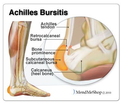 Achilles Bursitis - the most common bursa to be inflamed in the foot is the retrocalcaneal bursa (also referred to as the subtendinous calcaneal bursa). #anklebursa Achilles Bursitis, Heel Bursitis, Achilles Pain, Achilles Tendon, Tight Hip Flexors, Psoas Muscle, Calf Muscles, Heel Pain, Hip Flexor