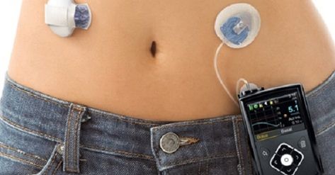 Kidney Damage, Insulin Pump, Blood Glucose Levels, Glucose Levels, Regulate Blood Sugar, Type 1, Disease, Engineering, Pumps