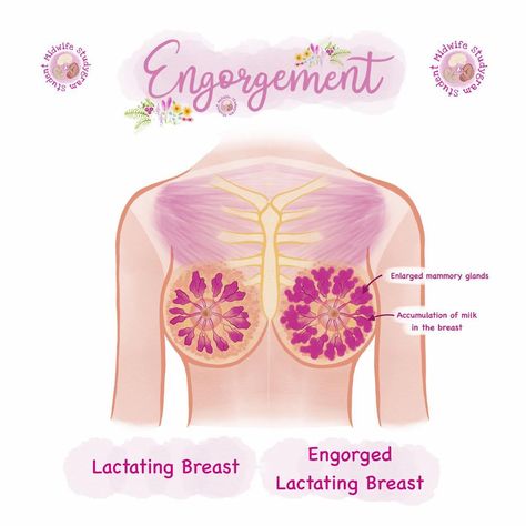 𝗦𝘁𝘂𝗱𝗲𝗻𝘁 𝗠𝗶𝗱𝘄𝗶𝗳𝗲 𝗦𝘁𝘂𝗱𝘆𝗴𝗿𝗮𝗺 on Instagram: “🤱🏾 Engorgement 🤱🏾 Initial physiological engorgement refers to the overfilling of the breasts, resulting in lymphatic and vascular…” Student Midwife Studygram, Midwife Aesthetic, Midwifery Student, Doula Business, Certified Medical Assistant, Student Midwife, Nurse Manager, Nurse Study Notes, Mother Baby Nurse