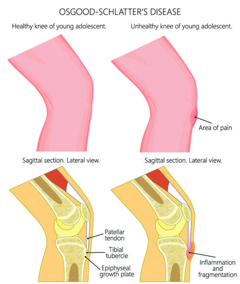 Can Osgood-Schlatter Disease Affect Adults? Knee Taping, Osgood Schlatter Disease, Disease Symptoms, Strengthening Exercises, Physical Development, Lower Leg, Mechanical Engineering, Knee Pain, Kids Stuff