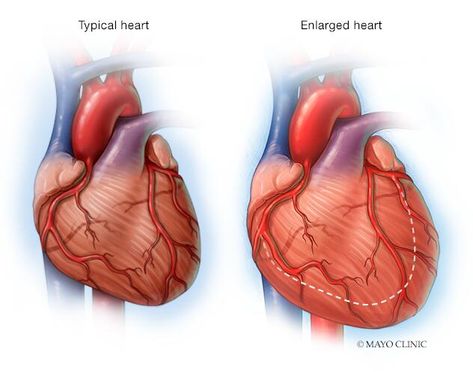 Enlarged Heart Symptoms, Heart Symptoms, Enlarged Heart, Blood Pressure Medicine, Gut Issues, Healthy Facts, Heart Muscle, The Healer, Heart Conditions