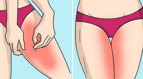 3 ways to Get Rid of Inner Thigh Rash! #rash #thigh #naturalcure #innerthighrash Chafing Remedies, Inner Thigh Rash, Thigh Chaffing, Rashes Remedies, Inner Thigh Chafing, Fitness Jokes, Thigh Chafing, Inner Thigh Workout, Tone Legs