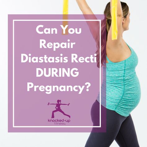 Can you repair diastasis recti during pregnancy? Great question! I share more in my video with lots of great tips and things you can start doing right now, even pregnant, to help possibly decrease slightly during pregnancy but more important help with healing postpartum. Diastis Recti Exercises, Healing Postpartum, Pregnancy Video, Diastasis Recti Repair, Exercise While Pregnant, Healing Diastasis Recti, Vegan Pregnancy, Diastasis Recti Exercises, Pregnancy Videos