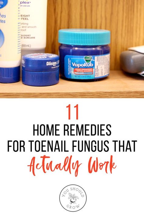 Foot Fungus Remedies, Fungal Infection Remedies, Toenail Fungal Infection, Nail Discoloration, Nail Remedies, Fingernail Fungus, Toenail Fungus Remedies, Nail Fungus Remedy, Nail Infection