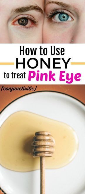 Pink Eye Remedy, Treating Pink Eye, Pink Eye Home Remedies, Natural Pink Eye Remedy, Honey Health Benefits, Pinkeye Remedies, Best Cough Remedy, Holistic Health Remedies, Health Blogger