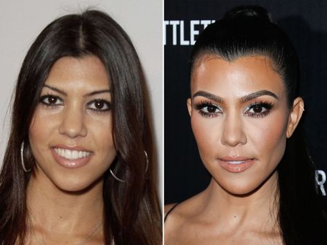 Kardashians Before And After, Kourtney Kardashian Makeup, Kardashian Plastic Surgery, Kourtney Kardashian Hair, Kim Kardashian Before, Chin Implant, Dark Brunette Hair, Celebrity Plastic Surgery, Baby Fat