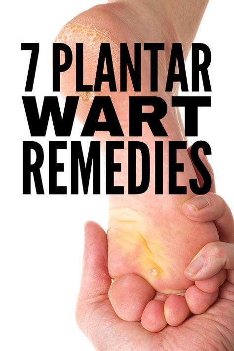 Plantar Wart Remedies, Planters Wart, Home Remedies For Warts, Warts Remedy, Get Rid Of Warts, Home Remedy For Cough, Skin Tags, Cold Sores Remedies, Natural Sleep Remedies