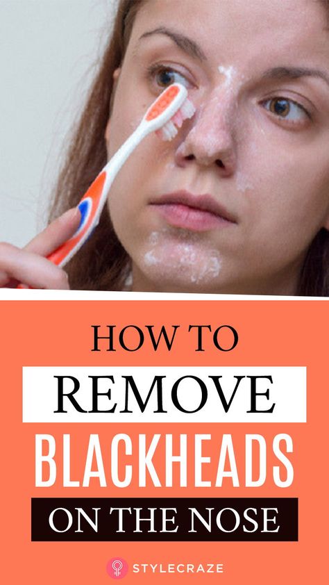 Acne Reasons, Remedies For Sickness, Remedies For Inflammation, Natural Remedies For Cold, Remove Blackheads From Nose, How To Remove Blackheads, All Natural Home, Natural Remedies For Cough, Blackhead Remedies