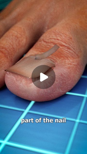 Ingrown Toenail Removal Videos, Ingrown Toenail Remedy, Ingrowing Toenail, Toe Nail Fungal Infection, Ingrown Toenail Remedies, Curved Toenails, Toenail Pain, Ugly Toenails, Infected Toenail