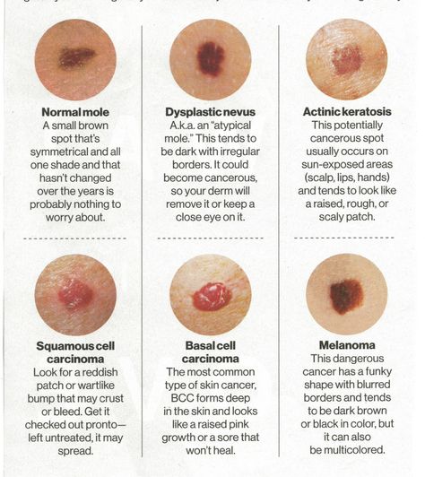 Skin Markings, Cancerous Moles, Skin Marks, Skin Moles, Blood Sugar Diet, Health Podcast, Health Signs, Medical School Motivation, Glamour Magazine