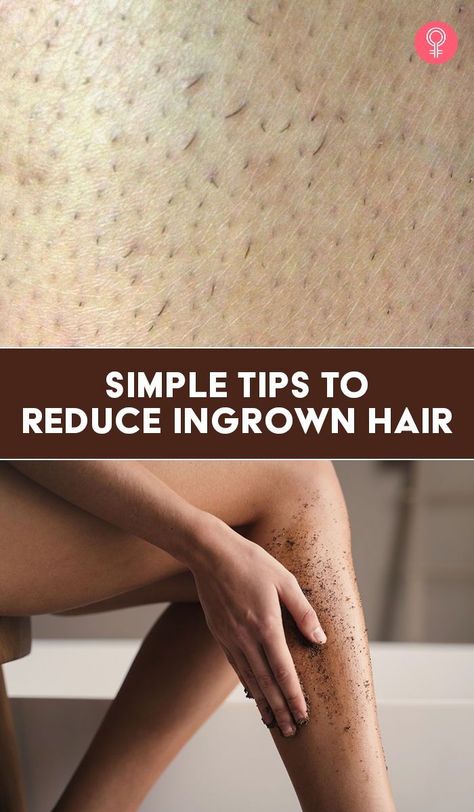 Simple Tips To Reduce Ingrown Hair: Pressing or poking these pimple-like bumps can sometimes lead to bacterial infections and even leave scars on the skin. So, if you are wondering about the way forward, we are here to help you out. In this article, you will explain what ingrown hair is, its causes, how to remove them safely, and a few tips to prevent its reoccurrence. Razor Bump, Female Facial Hair, Ingrown Hair Remedies, Bump Hairstyles, Ingrown Hair Removal, Hair Curl, Hair Removal Remedies, Healing Salves, Unwanted Facial Hair