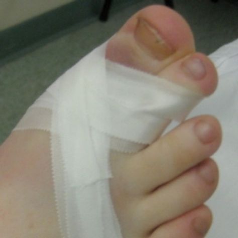 Many people struggle each year with the embarrassment of crooked toes. This usually becomes an issue during the warmer months when they visit the beach or the pool and are going barefoot. For women with crooked toes, wearing open toe shoes or... Hammertoe Remedies, Hammer Toe Correction, Get Rid Of Corns, Adrian Chase, Toe Straightener, Foot Exercises, Mole Removal, Foot Pain Relief, People Struggle