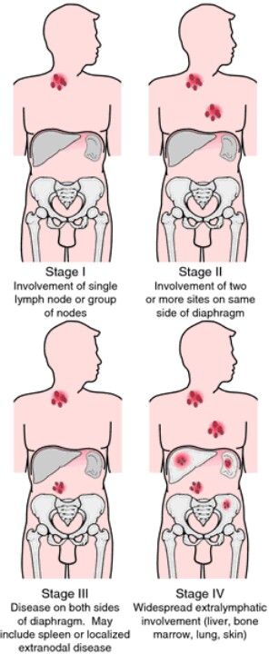 Hodgkins lymphoma. I was Stage 4: neck, chest, throat, spleen. This pinner has had neck nodes for years and needs to be reminded to monitor this! Love graphics, but this is scary. Hodgkin Lymphoma, Medical Dictionary, Lymphoma Awareness, Oncology Nursing, Nursing Study, Nursing Education, Nursing Notes, Science, Not Found