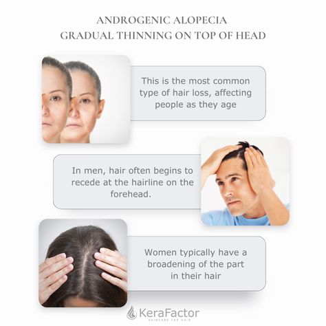 Dealing with androgenic alopecia? This common condition causes gradual thinning at the top of the head. KeraFactor targets scalp health to support fuller-looking hair and help you take control. 💆‍♀️ #AndrogenicAlopecia #HairHealth #KeraFactor #FullerLookingHair Androgenic Alopecia, G Hair, Scalp Health, Take Control, At The Top, Hair Health, The Head, Hair Hair, The Top