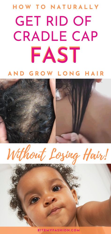 What is cradle cap? Does your baby have cradle cap? Easy, fast cradle cap removal for baby's hair. Grow baby's hair long and healthy. Naturally remove cradle cap with these easy tips.  These natural cradle cap remedies are perfect for Black baby hair care and to grow your baby's hair long. #babycare #cradlecap #growbabyshair #babyhair Coconut Oil For Cradle Cap, Natural Remedies For Cradle Cap, Natural Cradle Cap Remedy, Cradle Cap Remedies For Adults, How To Get Rid Of Cradle Cap, Newborn Hair Care, Baby Hair Growth Remedies, Baby Losing Hair, Baby Dry Scalp