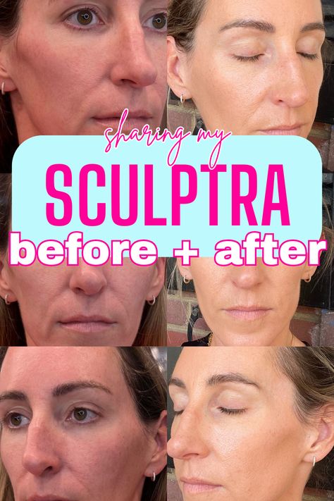 Why I Decided To Get Sculptra   My Sculptra Before and After Thermage Before And After, Facial Balancing Before And After, Laser Facial Before And After, Cool Sculpting Before And After, Semiglude Before And After, Sculptra Before And After, Sculptra Before And After Faces, Face Sculpting, Ultherapy Before And After