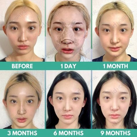 Pimples Between Eyebrows, Cheekbone Reduction, Deep Pimple, Kpop Plastic Surgery, Jaw Reduction Surgery, V Line Surgery, Plastic Surgery Korea, Plastic Surgery Fail, Korean Plastic Surgery