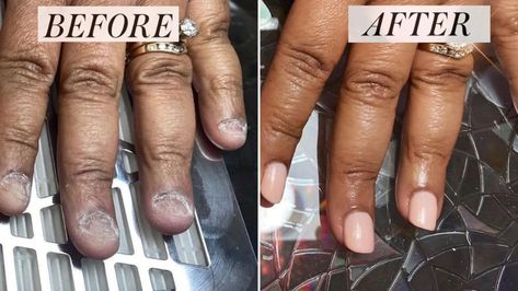 How This Manicurist Transformed Her Client’s Bitten Nails | Allure Bitten Nails, Fix Broken Nail, Manicure Pictures, Nails After Acrylics, Nail Problems, Ten Nails, Broken Nails, Nails Green, Nail Repair