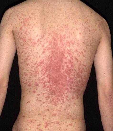 pityriasis rosea skin rash photos - Christmas Tree Distribution Medical Photos, Glow Skin, Black Christmas Trees, Skin Disorders, Workspace Inspiration, Skin Diseases, Christmas Tree Pattern, Presents For Men, Tree Pattern