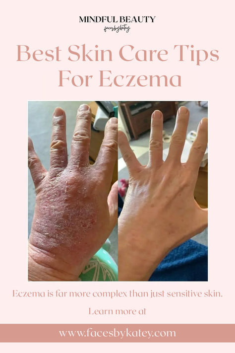 Learn what eczema and skin sensitivities are, and tips for how to care for eczema with skin care, common triggers, and more ways to support calm healthy skin. Excema Treatments Diy, Severe Excema Remedies, Exema Treatments Natural, Excema Remedies Diy, Common Triggers, Rash On Face, Cucumber Detox Water, Lemon Cucumber, Hydrating Drinks