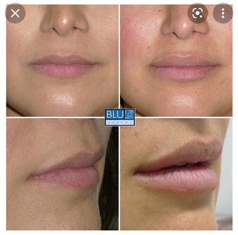 Dermal Fillers Lips, Juvederm Lips, Botox Before And After, Permanent Lipstick, Exfoliating Lip Scrub, Best Lip Gloss, Homemade Lip Balm, Botox Fillers, Sugar Lip Scrub