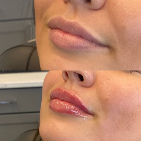 Lip Implants Before And After, Natural Botox Lips, M Shaped Lips Before And After, Lips Botox Natural, Restalyne Before And After Lips, Aesthetic Dental, Botox Lips, Lips Inspiration, Iphone Wallpaper Yellow