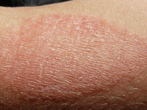 Many common issues can cause patches of dry skin, including cold weather, allergies, and certain medical conditions, including eczema and psoriasis. In this article, we look at symptoms, treatments, and pictures of dry skin patches. Dry Skin Pictures, Dry Patches On Skin, Skin Allergy Pictures, Skin Rashes Pictures Types Of, Dry Patches On Face, Dry Skin Patches On Face, Skin Conditions Pictures, Skin Rashes Pictures, Skin Disease Pictures