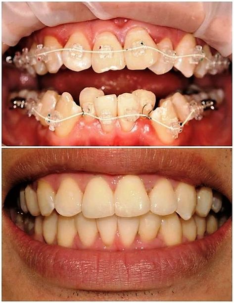 Braces Before And After, Dental Assistant Humor, Dental Orthodontics, Enid Oklahoma, Dental Spa, Dental Facts, Dental Tourism, Dental Life, Dental Braces