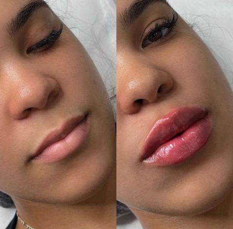 Our signature lip filler technique promises you the most enchanting, natural-looking pout you’ve ever dreamed of. Don’t just imagine the transformation—experience it. Book your appointment or consultation today and embrace the allure of irresistible lips 💉  For appointments or free consultations, DM or call 🌸  📲 (917) 701-0253  📞 (585)441-3838  #lipfillernewyork #lipfillersnewyork #lipfillernyc #lipinjectionsnyc #lipinjectionsnewyork #lipfillerbronx #lipfillersbronx #lipsinjectionnyc Lip Filler 2ml, Lip Fillers Cupids Bow, Lip Filler Before And After, Lip Filler M Shaped Lips, Lip Filler Inspo 0.5ml, 0.55ml Lip Filler, Dermal Fillers Lips, Makeup Artist Tips, Lip Injections