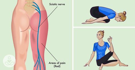 Siatic Streches, Yoga Poses For Sciatica, Yoga For Sciatica, Sciatica Stretches, Hip Problems, Sciatica Exercises, Piriformis Syndrome, Sciatica Pain Relief, Easy Yoga Poses