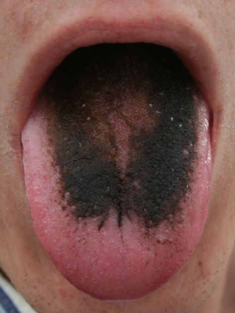 List of skin conditions - Wikiwand Human Tongue, Black Tongue, Medical Photos, Dental Problems, Oral Hygiene, Dental Health, Skin Conditions, Oral Health, Dental Care