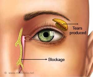 Blocked Tear Duct, Tears In Eyes, Health Disease, Nursing School Survival, Eye Infections, Health Signs, Organ Donation, Watery Eyes, Drainage System