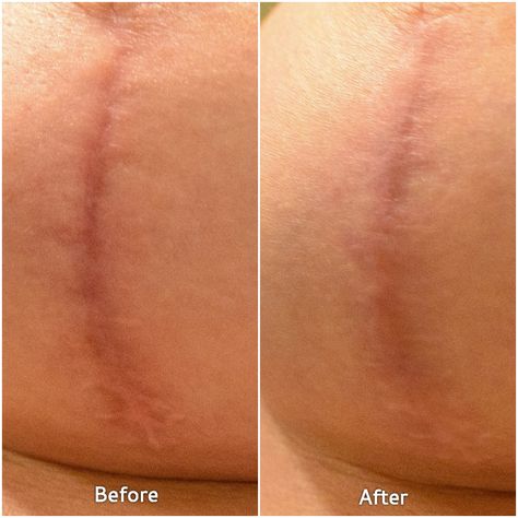 Healing from Surgery with Embrace Scar Therapy - The Road Les Traveled Scar Healing Remedies, Healing From Surgery, Scar Healing, Mastectomy Scars, Scar Face, Mastectomy Recovery, Scar Remedies, Breast Lift Surgery, Double Mastectomy