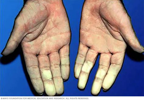 Raynaud's disease - Symptoms and causes - Mayo Clinic Reynauds Syndrome, Scleroderma Symptoms, Medical Symptoms, Sjogrens Syndrome, Disease Symptoms, Autoimmune Disorder, Mayo Clinic, Autoimmune Disease, Chronic Illness