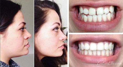 How to fix underbite without jaw surgery? Dr. Ivanov and his technique with dental braces are popular to fix an underbite without surgery. Here are some of the most effective methods for underbite correction. Read More Today! Jaw Surgery Before And After Underbite, Underbite Before And After, Underbite Braces, Braces Transformation, Braces Before And After, Exercise To Reduce Hips, Double Jaw Surgery, Mouth Problems, Orthognathic Surgery