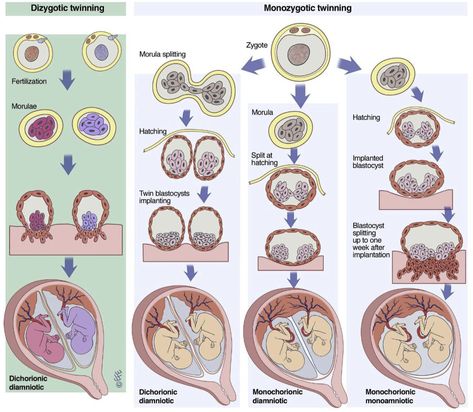 TRA Types Of Twinning Image Types Of Twins, Midwifery Student, Restless Leg Syndrome, Medical School Essentials, Twin Pregnancy, Pregnancy Symptoms, School Help, Medical Research, Medical Education