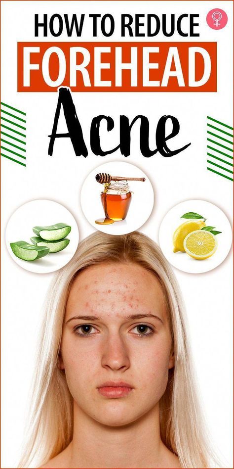 How To Reduce Forehead Acne, Forehead Acne Home Remedies, Acne On Forehead, Forehead Acne Cause, Pimples On Forehead, Back Acne Remedies, Teenage Acne, Forehead Acne, Pimples Under The Skin